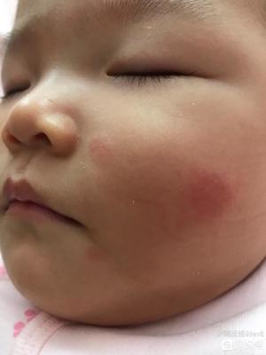 七个月宝宝起疹子怎么办