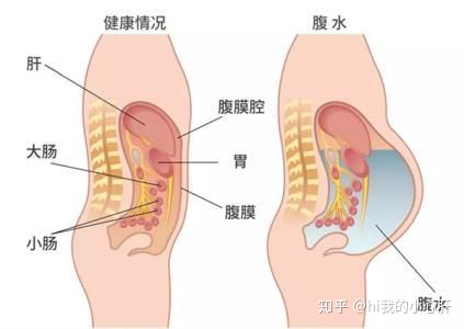 每天可以放多少腹水