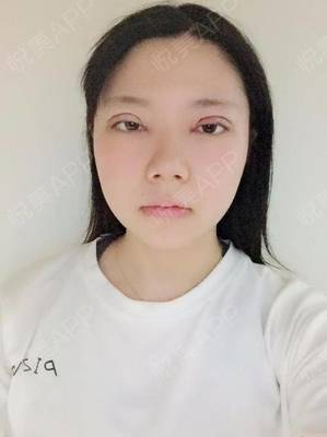 割双眼皮消炎针打几天