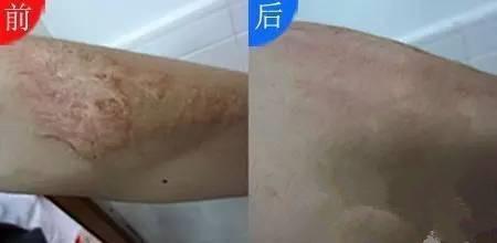 痘痘留下疤痕怎么办