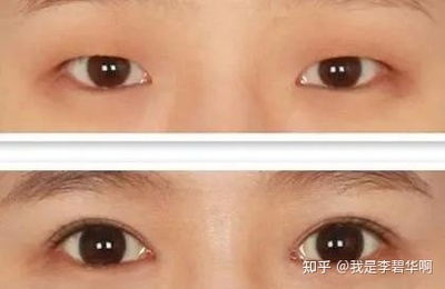 小眼睛适合做双眼皮吗