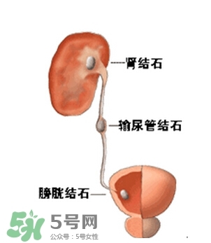 尿道结石一天要喝多少水