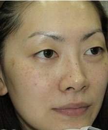 脸颊长斑是怎么回事