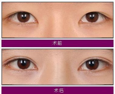 哪做双眼皮好