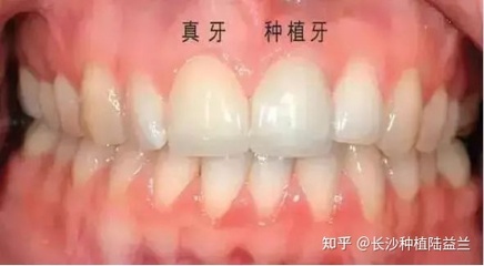 种牙好还是镶牙好