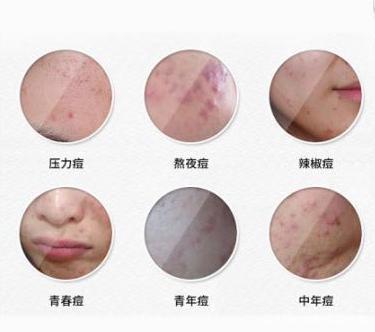 为什么长痘痘不能吃糖