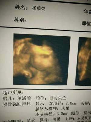 胎儿头位是入盆了吗