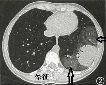 肺里有白痰是怎么回事