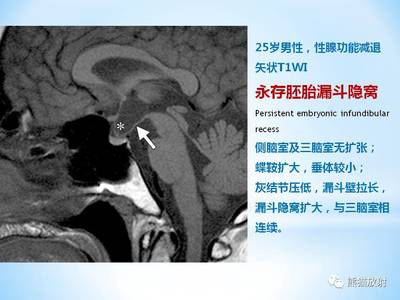 侧脑室扩张是怎么回事