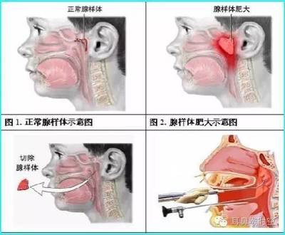 腺样体肥大怎么治疗最好