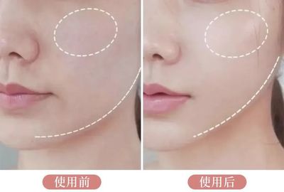 抢打痘痘