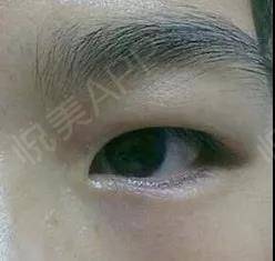 老贴双眼皮贴会怎么样