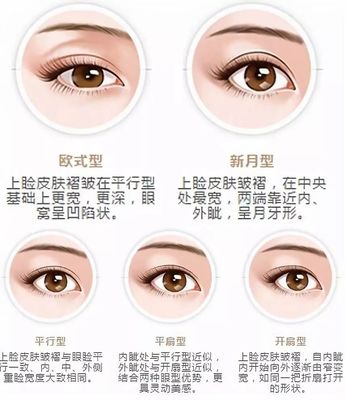 三点定位双眼皮用拆线吗