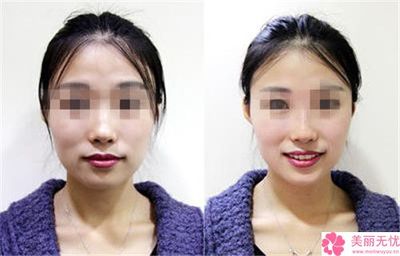 隆鼻整形效果