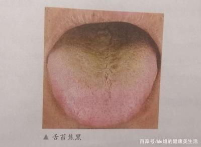 舌苔灰色是怎么回事