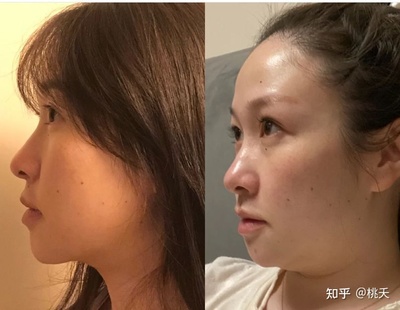 哪抽脂比较好