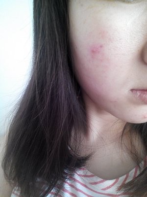 痘痘怎么起的