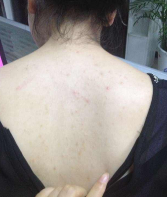 皮肤后背起痘痘怎么回事啊