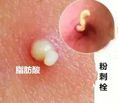怎样区别是痘痘还是螨虫