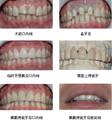 弄了烤瓷牙后牙齿还会长吗