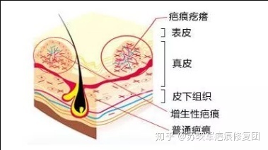 怎样能治好痘痘