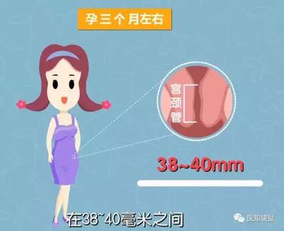 孕妇宫颈长度