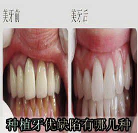 上皮隔名词解释口腔