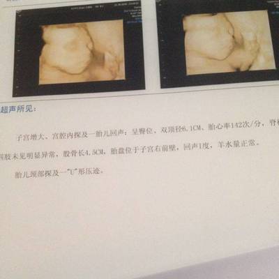 怀孕臀位怎么办