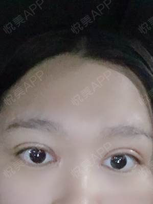 开双眼皮疼吗