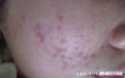 怎么预防炎症痘痘