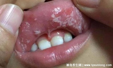 宝宝口疮图片