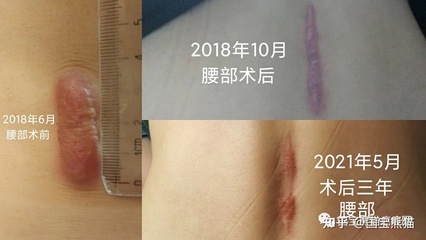疤痕放疗