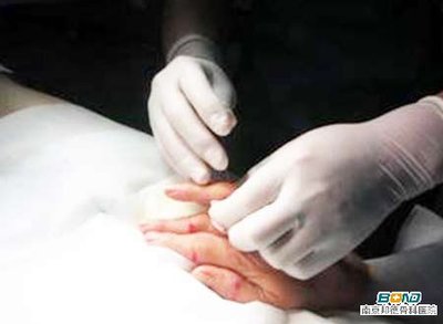 手指关节炎怎么治疗
