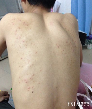 男生长痘痘要注意什么问题