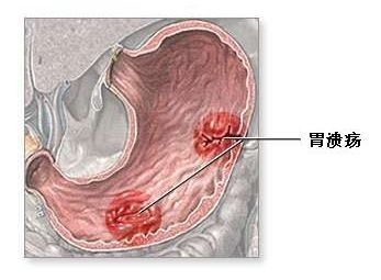 胃糜烂出血怎么治疗