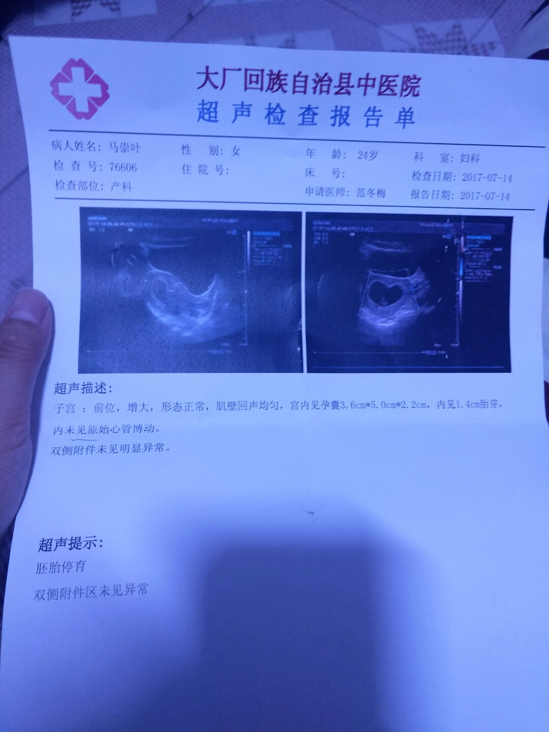 怀孕一个月胎儿有多大