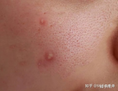 痘痘一直有脓包怎么办