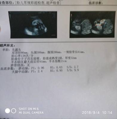 胎儿sd值偏高怎么回事