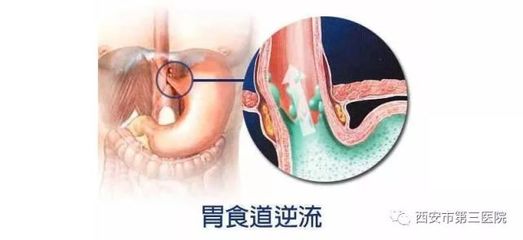 食道反酸是怎么回事