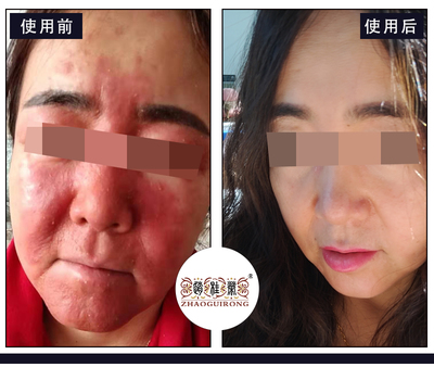 玫瑰痤疮怎么治疗最快