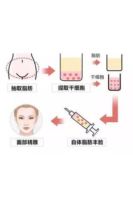 脂肪填充还是玻尿酸好