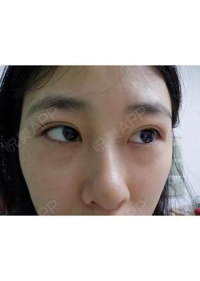 埋线双眼皮能拆吗