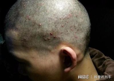 背后长满痘痘怎么治疗
