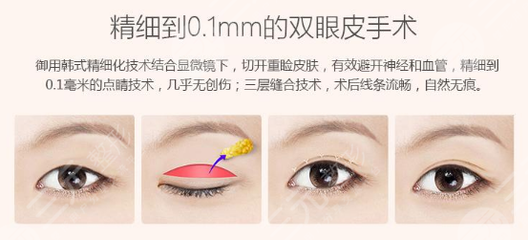 韩式做双眼皮价格