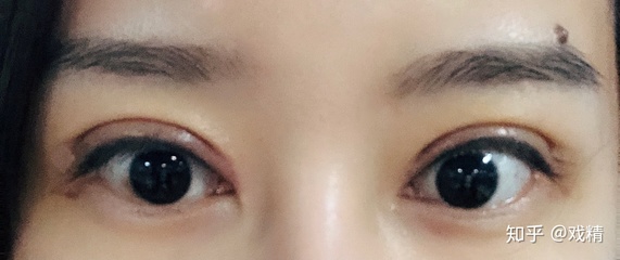眼皮上长痘怎么办