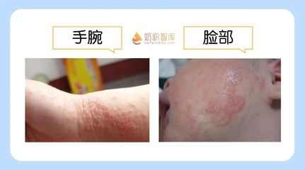 荨麻疹可以喝奶粉吗