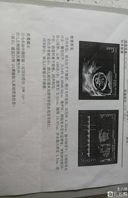 胎儿左侧脉络丛囊肿