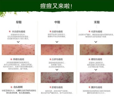 去痘痘 痘印