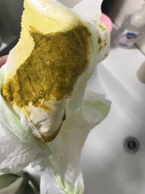 宝宝的便便有酸臭味