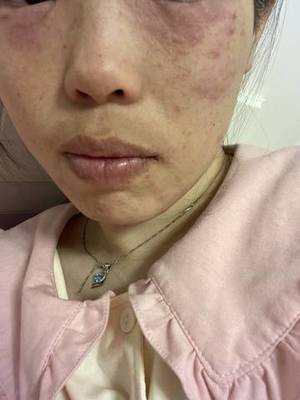 怀孕脸上过敏